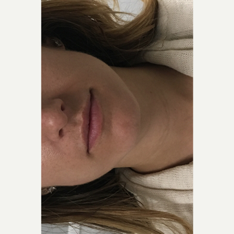 25-34 year old woman treated with Restylane Silk before 3837059