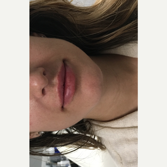 25-34 year old woman treated with Restylane Silk after 3837059