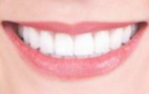 25-34 year old woman treated with Porcelain Veneers- 6 Porcelain Veneers & 4 Porcelain Onlays after 2293365