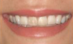 25-34 year old woman treated with Porcelain Veneers- 6 Porcelain Veneers & 4 Porcelain Onlays before 2293365