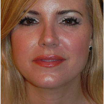 35-44 year old woman treated with Kybella after 3659026