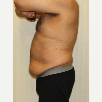 55-64 year old man treated with Male Tummy Tuck before 3286199