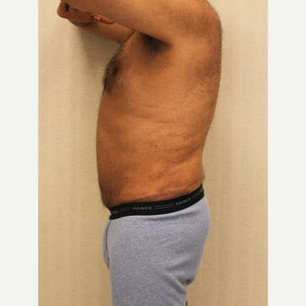 55-64 year old man treated with Male Tummy Tuck after 3286199