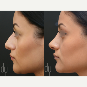 Primary Open Rhinoplasty and Septoplasty before 3322576
