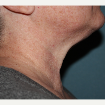 55-64 year old female 1 treatment with Kybella after 3185592