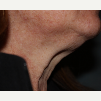 55-64 year old female 1 treatment with Kybella before 3185592