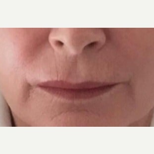 55-64 year old woman treated with Lip Augmentation with Restylane Silk after 2541237