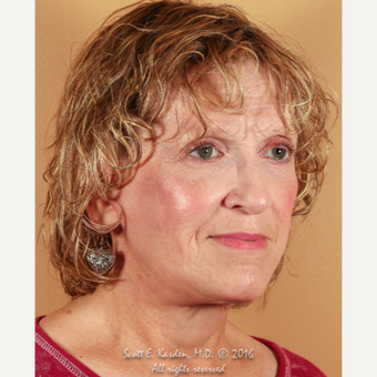 65-74 year old woman treated with SMAS Facelift after 3612161