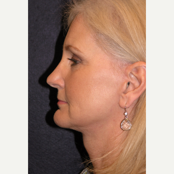 55-64 year old woman treated with Laser Resurfacing after 3466803