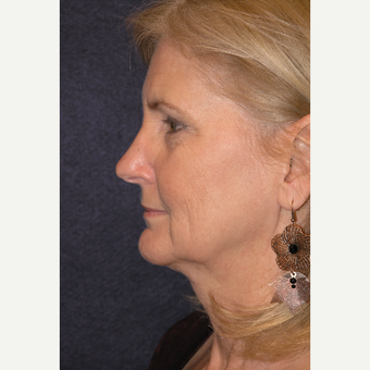 55-64 year old woman treated with Laser Resurfacing before 3466803