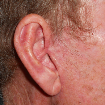 45-54 year old man treated with Mohs Surgery for a basal cell carcinoma on the ear after 3183957