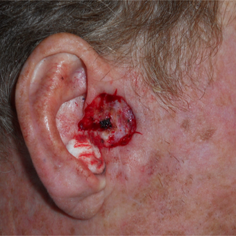 45-54 year old man treated with Mohs Surgery for a basal cell carcinoma on the ear before 3183957