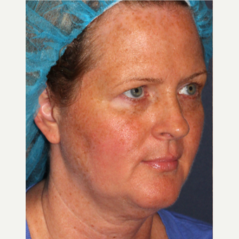 35-44 year old woman treated with Fraxel Laser and Alexandrite for sun damage removal before 3346103