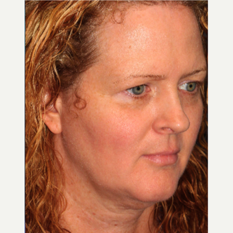 35-44 year old woman treated with Fraxel Laser and Alexandrite for sun damage removal after 3346103