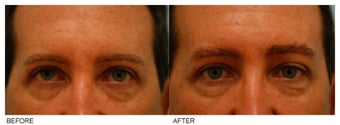 Eyebrow Hair Transplant before 134781