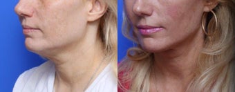 45-54 year old woman treated with Chin Liposuction before 1688819