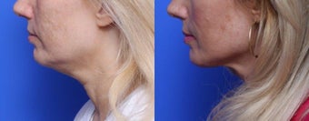 45-54 year old woman treated with Chin Liposuction after 1688819