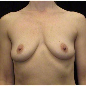 43 year old woman treated with Breast Augmentation after 3103577
