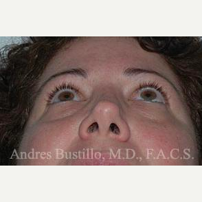 40 year old woman treated with Revision Rhinoplasty before 3460769
