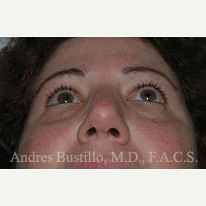 40 year old woman treated with Revision Rhinoplasty after 3460769