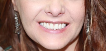 30 year old female treated with All-on-4 Dental Implant Procedure after 1053427