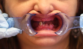 30 year old female treated with All-on-4 Dental Implant Procedure before 1053427