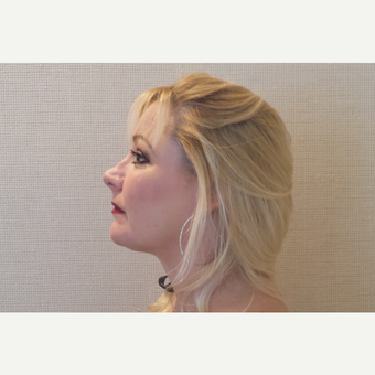 25-34 year old woman treated with Chin Liposuction after 3659811