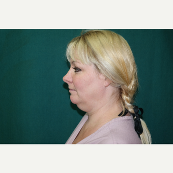 25-34 year old woman treated with Chin Liposuction before 3659811