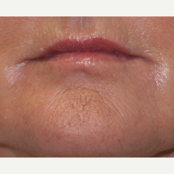55-64 year old woman treated with Lip Augmentation after 3758776