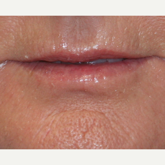 55-64 year old woman treated with Lip Augmentation before 3758776