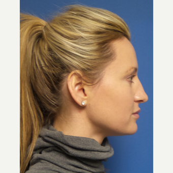 33 year old woman treated with Rhinoplasty and septoplasty before 3326533