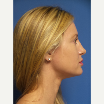 33 year old woman treated with Rhinoplasty and septoplasty after 3326533
