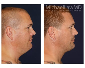 Chin Liposuction before 1256096