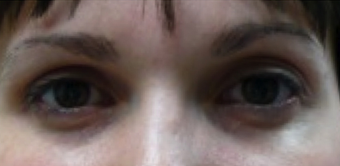 Botox Used To Treat Eye Wrinkles and Change Eye Shape before 1367249