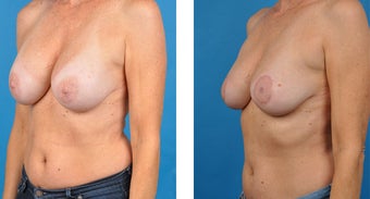 56 Year Old Woman, Breast Implant Removal with Internal Lift 1040020