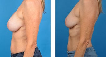 56 Year Old Woman, Breast Implant Removal with Internal Lift after 1040020