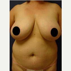 45-54 year old woman treated with Mini Tummy Tuck before 2073976