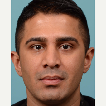 35-44 year old man treated with Revision Rhinoplasty before 3064807