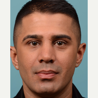 35-44 year old man treated with Revision Rhinoplasty after 3064807