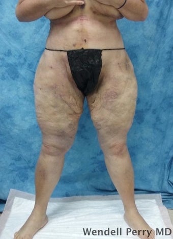 45-54 year old woman treated with Tummy Tuck after 3350926