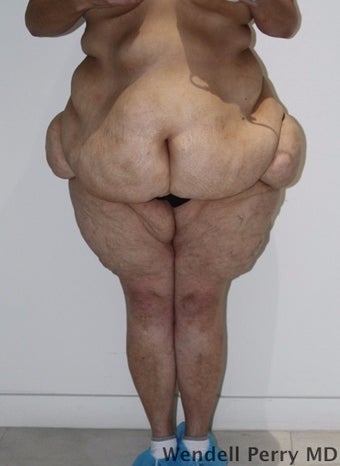 45-54 year old woman treated with Tummy Tuck before 3350926