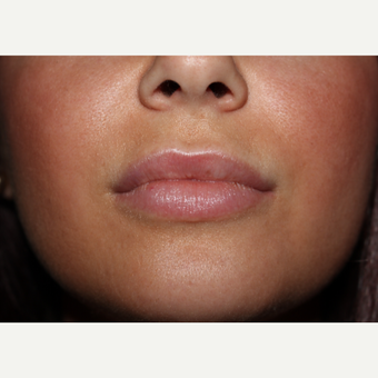 29 year old woman treated with 2cc's Juvederm Ultra to lips and around mouth after 3185400