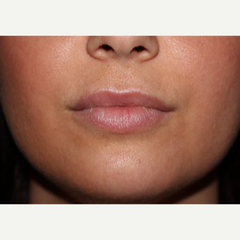 29 year old woman treated with 2cc's Juvederm Ultra to lips and around mouth before 3185400