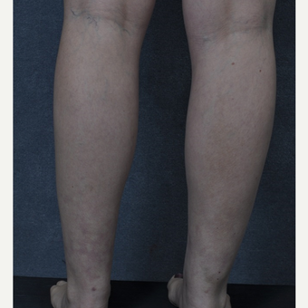 25-34 year old woman treated with Liposuction to the ankles after 3816093