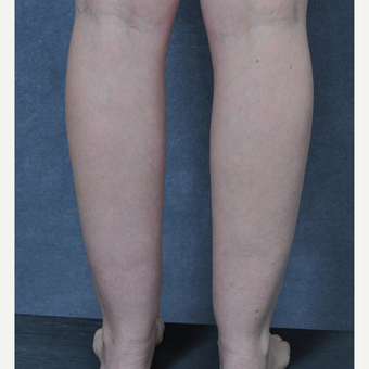 25-34 year old woman treated with Liposuction to the ankles before 3816093