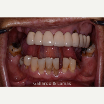 55-64 year old man treated with All-on-4 Dental Implants before 3075208
