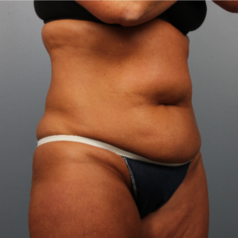 45-54 year old woman treated with CoolSculpting before 3507418