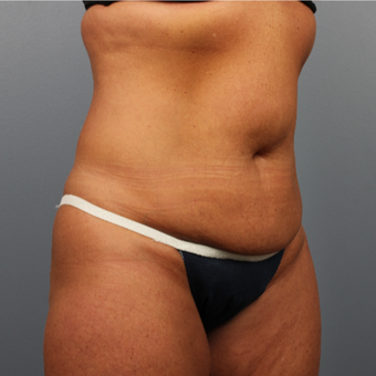 45-54 year old woman treated with CoolSculpting after 3507418