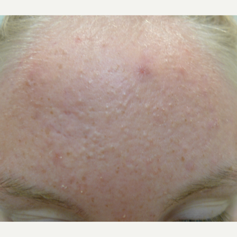 BHA peels for comedomal acne before 3731869