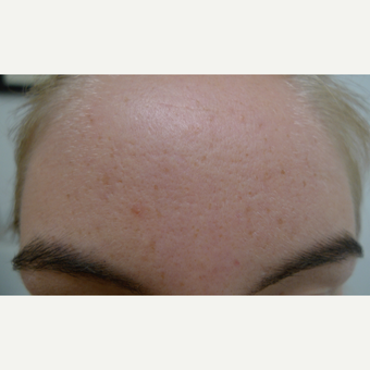 BHA peels for comedomal acne after 3731869